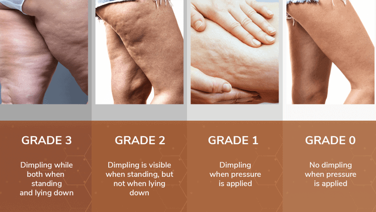 Does Cellulite Go Away When You Lose Weight What Causes Cellulite and the Most Effective Cellulite Treatments
