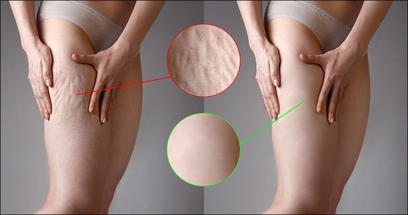 Cellulite on Woman's Legs