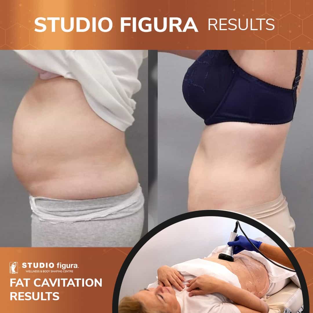 Fat Cavitation Results