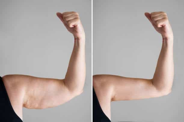 Fat Cavitation on Arms Before and After