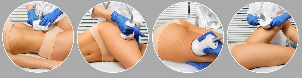 Body Parts that can be treated with Fat Cavitation, Thighs, Stomach, Arms, Love handles, Banana roll, bra line