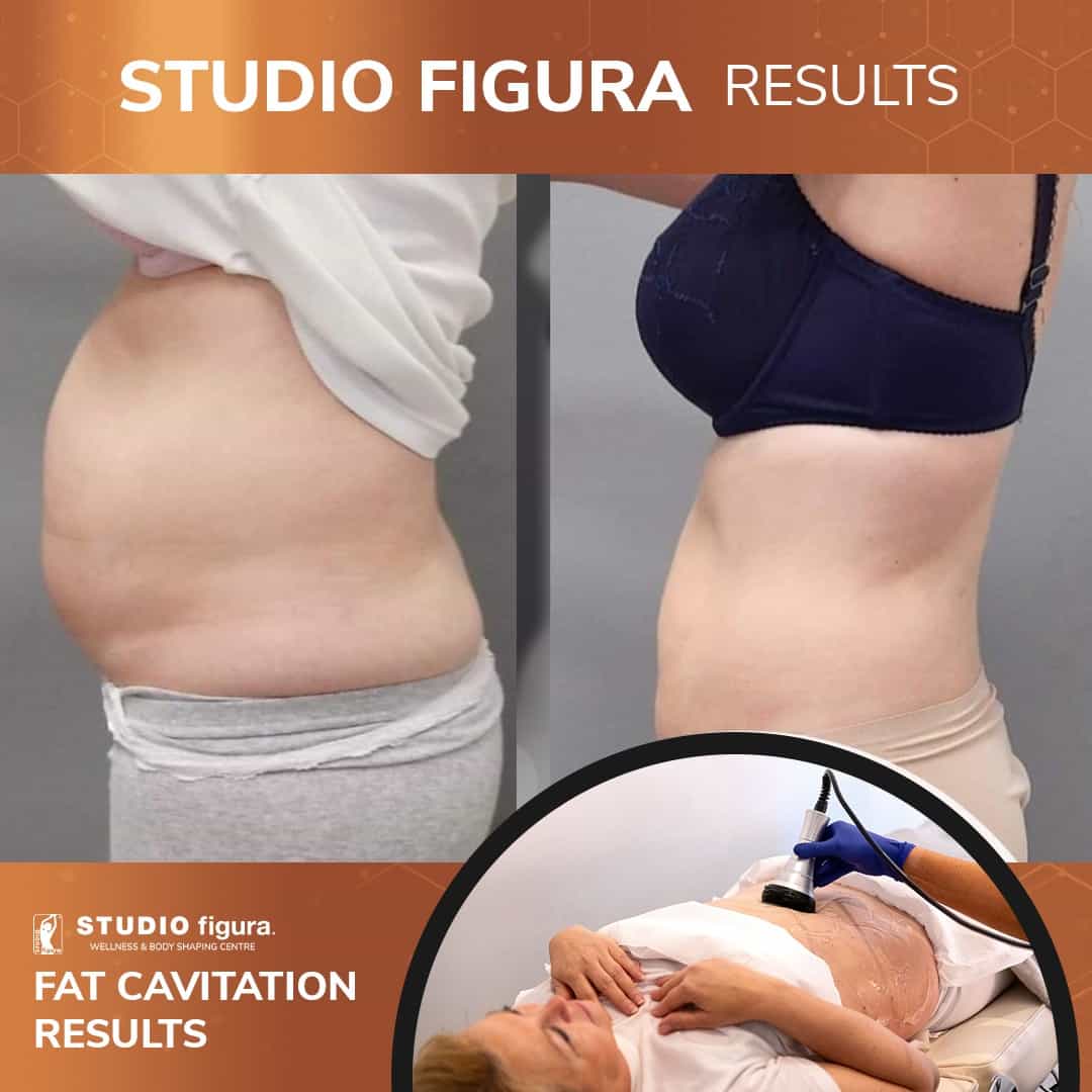 Fat-Cavitation-Results.jpg