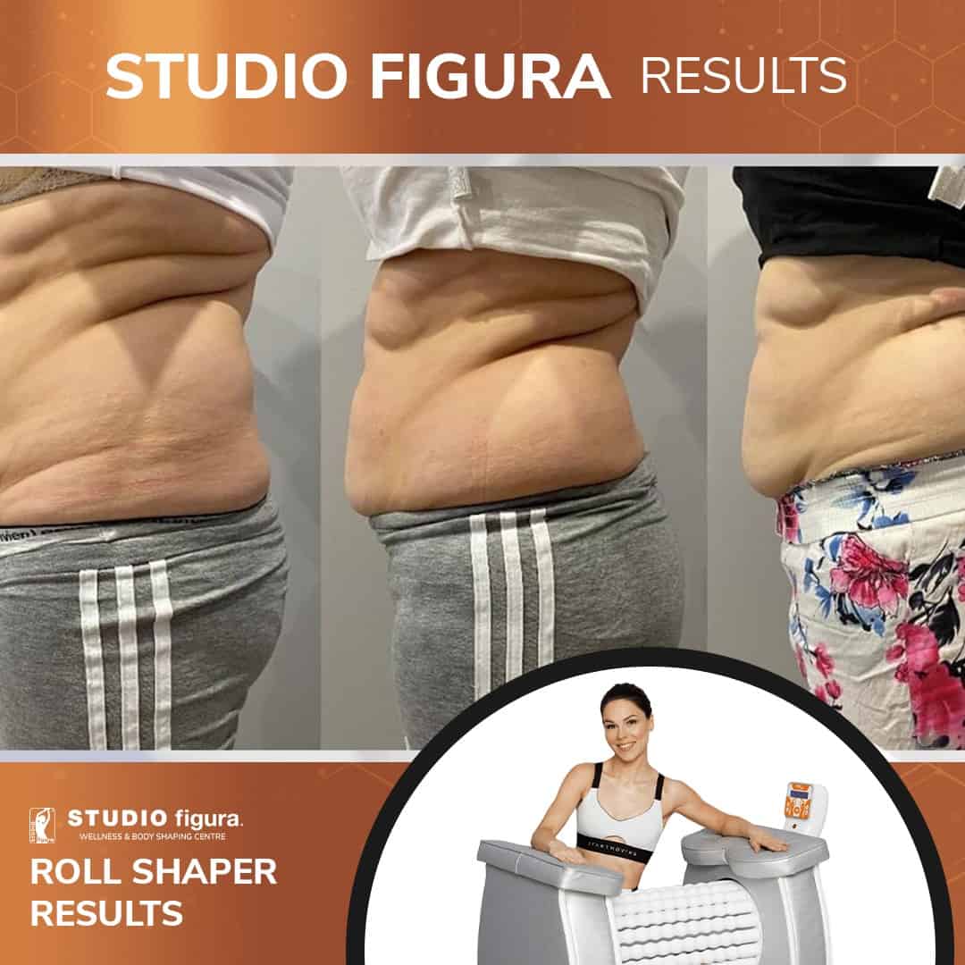 Roll-Shaper-Treatment.jpg