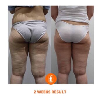 Studio Figura Cellulite Treatment Results Before and After Photo