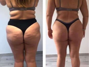 Studio Figura Cellulite Treatment Results Before and After Photo